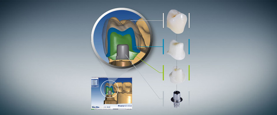 Ceramill TI Connect