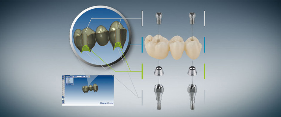 Ceramill TI Connect SR