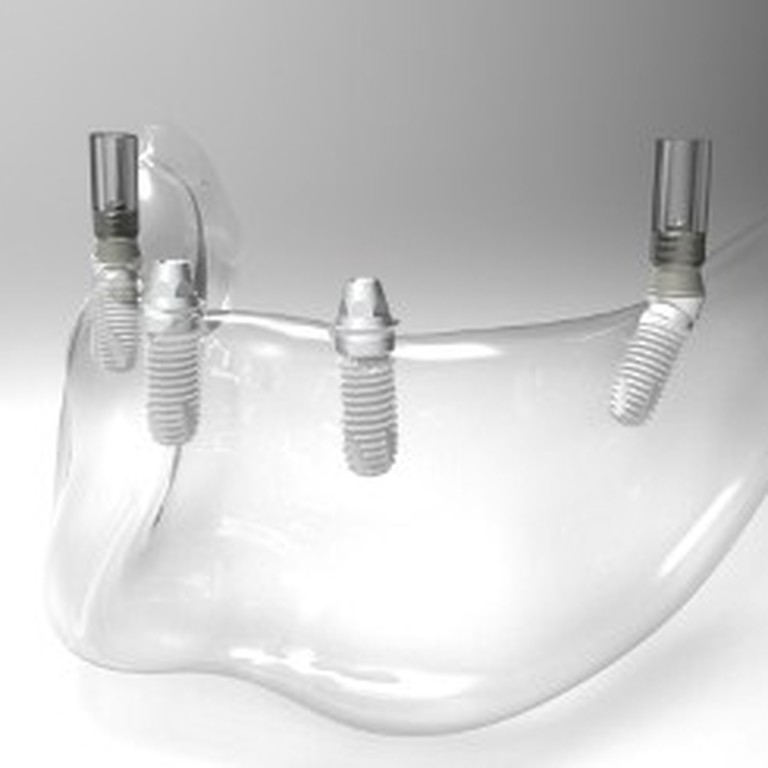Individual solutions by Bego Implants
